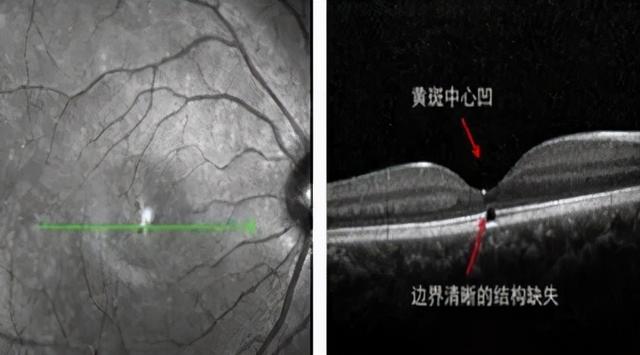 激光防護(hù)(激光個(gè)人防護(hù)措施)  第3張